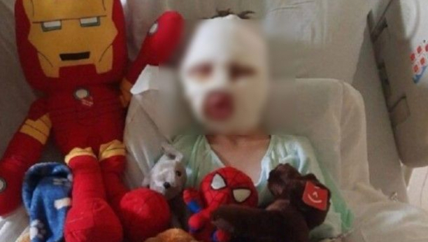 DEČAK (8) ZAPALIO DRUGARA (6) NA JAKO BIZARAN NAČIN: Vrlo mučan prizor, zbog neopreznosti roditelja šestogodišnjaku je unakaženo lice (FOTO)