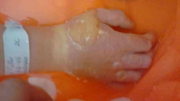 DEVOJČICA (4) ZADOBILA UŽASNE OPEKOTINE Dodirnula je ovu opasnu biljku koja izgleda kao korov i raste u dvorištima