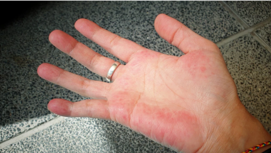 POGLEDAJTE U DLANOVE Ako vam ovako izgledaju, moguće je da je jetra ozbiljno bolesna