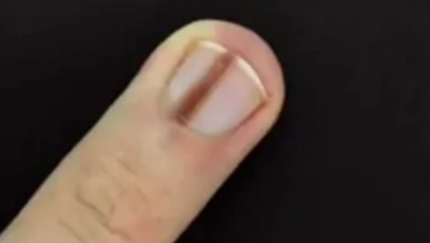 NIKADA NE IGNORIŠITE OVE PROMENE NA NOKTIMA Neke izgledaju bezazleno, a mnogu da budu da budu simptom smrtonosne bolesti