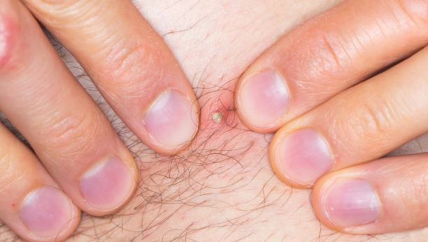 ZBOG URASLE DLAKE PROVEO JE ČETIRI MESECA U KOMI Lekari su se satima borili za njegov život, evo kad ovo može da bude smrtonosna