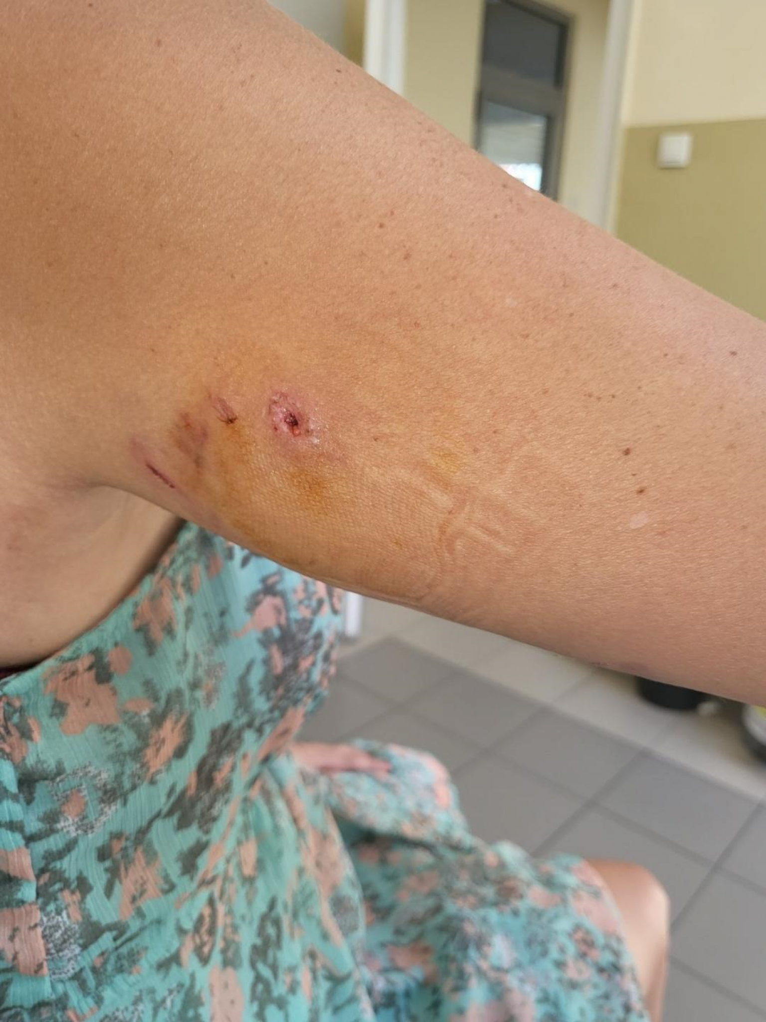 PRESTRAVLJENA Ispovest Beograđanke koju je napala krvoločna životinja na Zvezdari: Akita unakazio ženu, vlasnik samo blenuo! (FOTO)