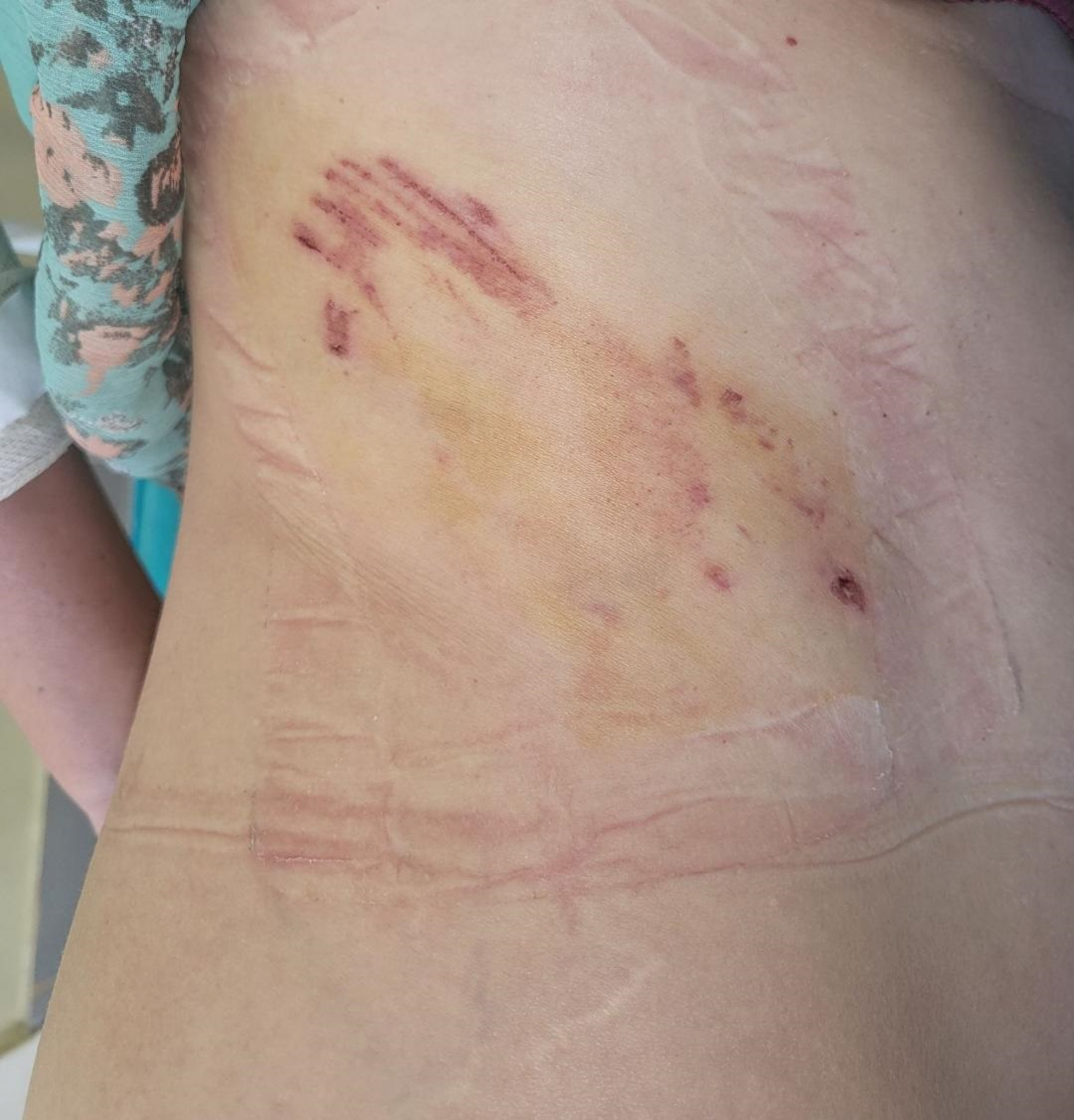 PRESTRAVLJENA Ispovest Beograđanke koju je napala krvoločna životinja na Zvezdari: Akita unakazio ženu, vlasnik samo blenuo! (FOTO)