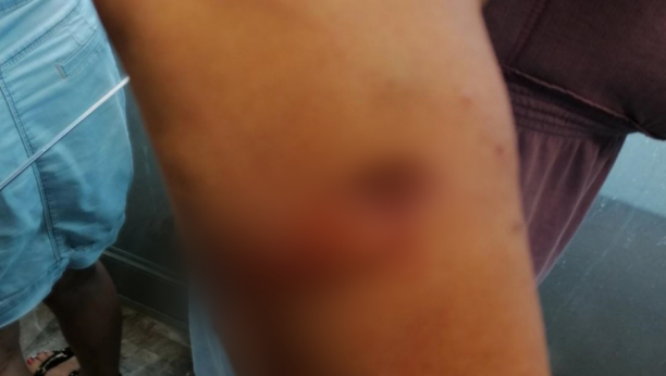 PRESTRAVLJENA Ispovest Beograđanke koju je napala krvoločna životinja na Zvezdari: Akita unakazio ženu, vlasnik samo blenuo! (FOTO)