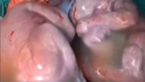 SVET GLEDA U ČUDU OVAJ SNIMAK Doktor uspeo da snimi rađanje blizanaca, ovakav slučaj se dešava jednom u 80.000 porošaja (VIDEO)