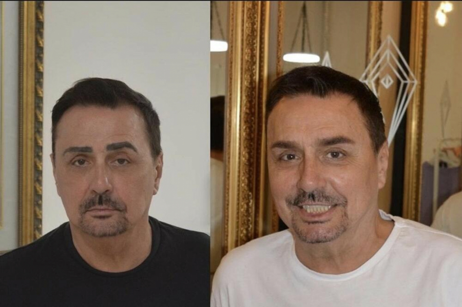 KEBA ZA NOVE OBRVE ISKEŠIRAO 600 EVRA Pevač se nakon trajne šminke odlučio na ovaj zahvat, fotke isplivale u javnost, evo kako sada izgleda (FOTO)