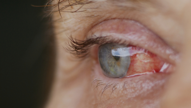 IZAZIVA POVRAĆANJE, JAKO KRVARENJE IZ NOSA I POPUCALE KAPILARE U OČIMA U ovom delu Evrope pojavio se opasan virus CCHF