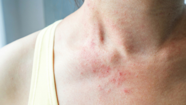 Neobična i retka alergija: Koji su simptomi vodene urtikarije?