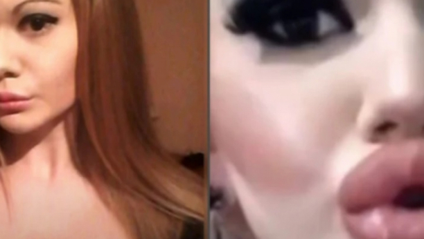 ANDREA IMA NAJVEĆE USNE NA SVETU, A SADA ŽELI I NAJVEĆE GRUDI Ona ima samo 23 godine, a zbog operacija je umalo OSLEPELA!