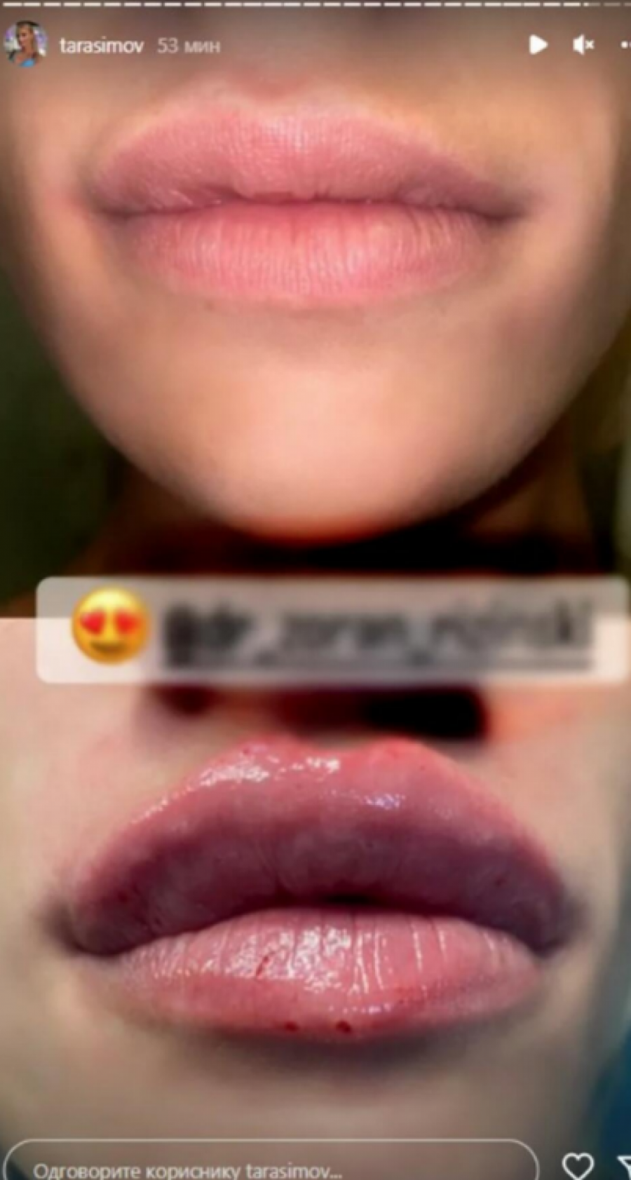 TARA OBJAVILA FOTKE PRE I POSLE! Otišla kod plastičara, pa pokazala svima šta je uradila