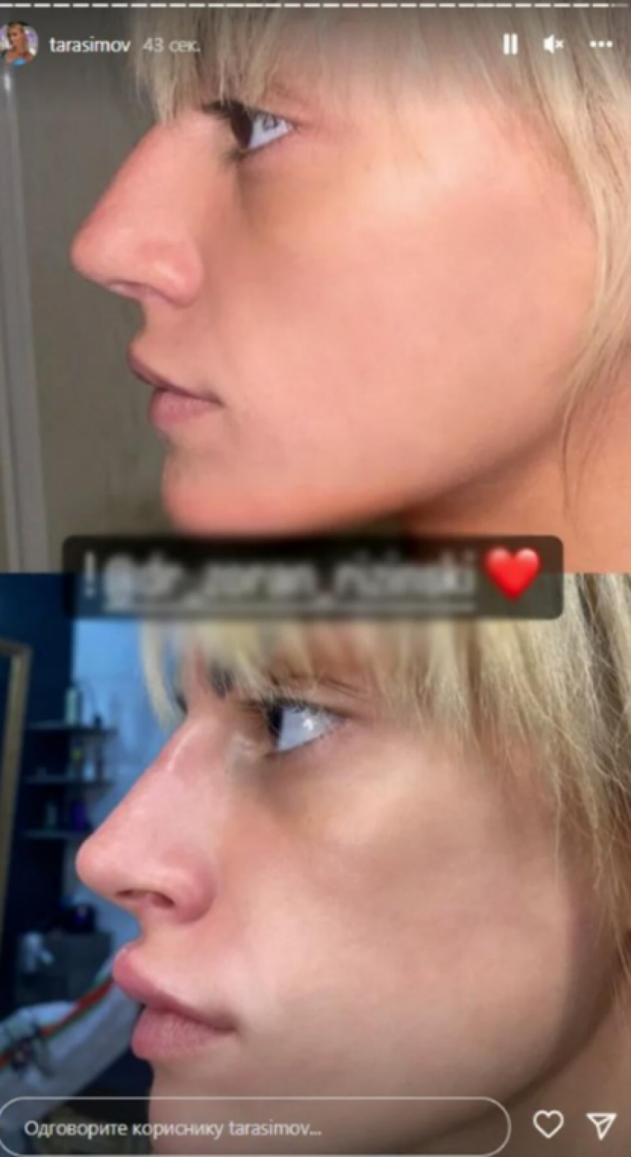 TARA OBJAVILA FOTKE PRE I POSLE! Otišla kod plastičara, pa pokazala svima šta je uradila