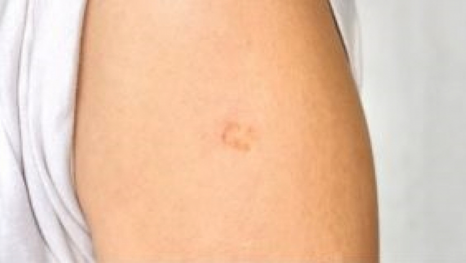 SVI KOJI SU ROĐENI U SFRJ GA IMAJU Iznenadiće vas zašto je nastao famozni ožiljak na levom ramenu