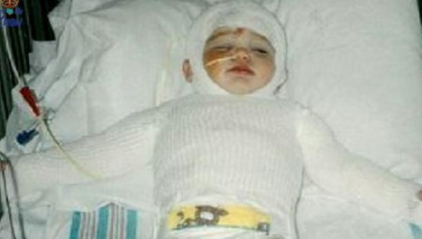 MAJKA STAVILA BEBU U VRELU RERNU Spasao je otac, evo kako danas posle brojnih operacija izgleda nesrećna devojčica