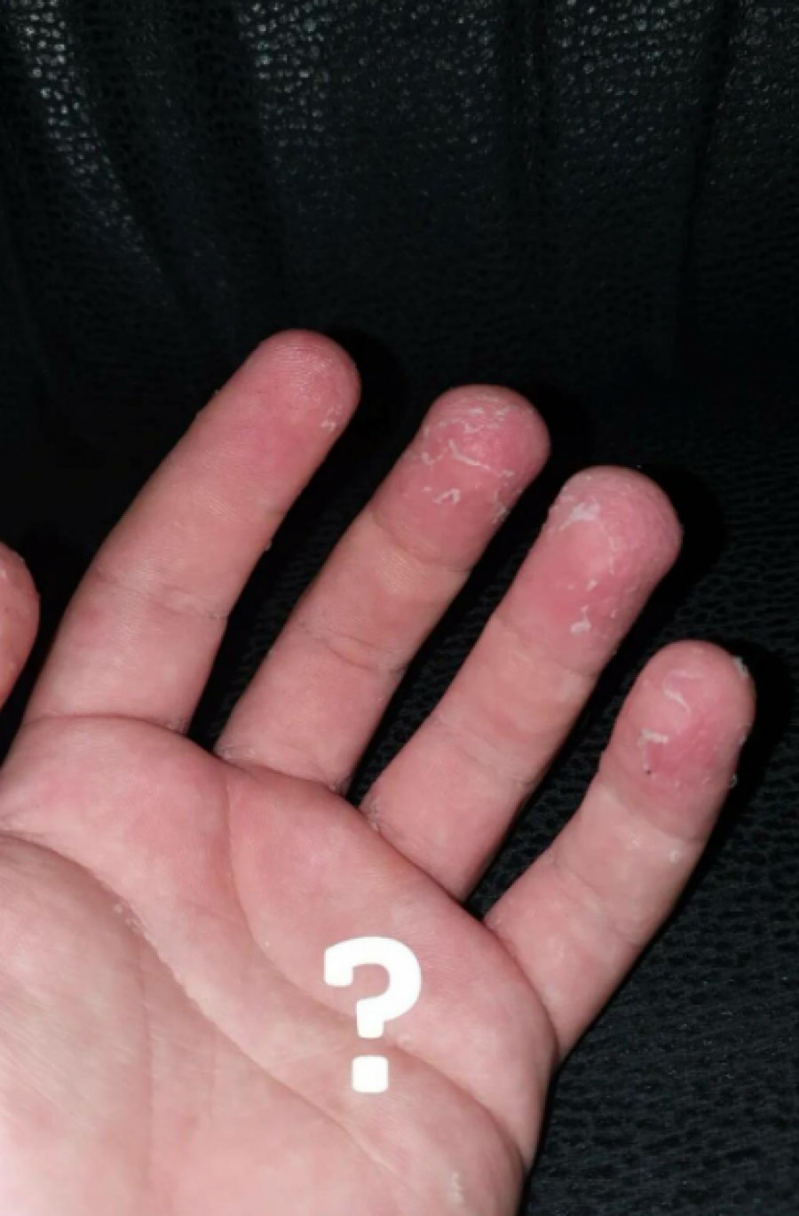 FINALISTA ZVEZDA GRANDA POKAZAO RANE NA KOŽI Pevač šokirao sve: Pijem tablete, neću da jadikujem! (FOTO)