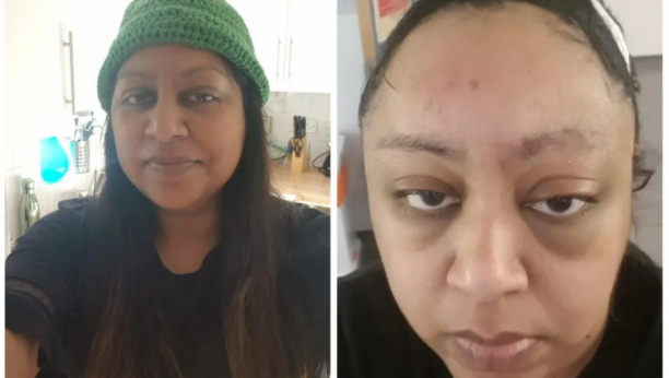 "MISLILA SAM DA MI ZUJI U UŠIMA OD UPALE SINUSA": Zbog smrtonosne bolesti dve godine nije plakala, život joj se preokrenuo nakon dijagnoze