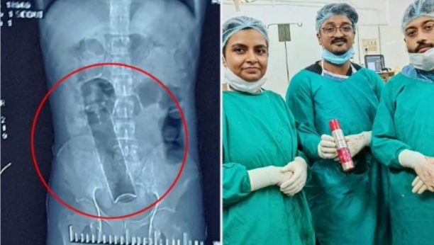 20 DANA NIJE VRŠIO NUŽDU!: Imao je nesnosne bolove i primljen je u hitnu, a hirurzi su se frapirali kada su videli šta se zaglavilo u analnom otvoru!