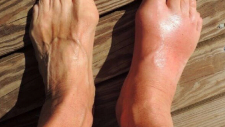 BOLNO OTICANJE NOGU Ne može da se izleči, ali postoje načini da se ublaži