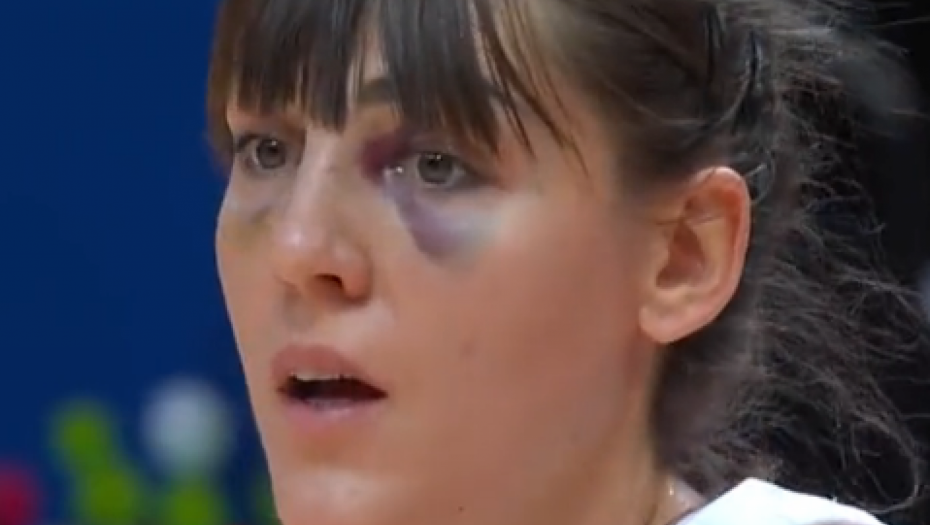 NAŠA RATNICA Tako se gine za Srbiju: Igrala sa slomljenim nosem, kad je skinula masku svi su ostalu u šoku zbog njenog lica (VIDEO)