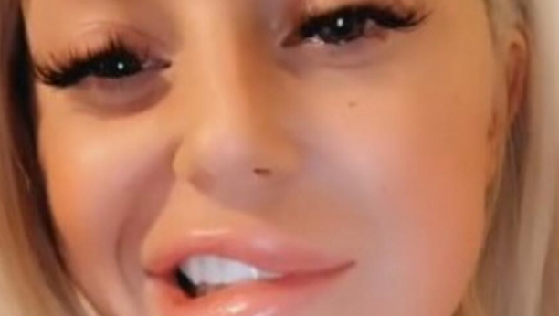 OTIŠLA NA ESTETSKI ZAHVAT, VRATILA SE SA ISKRIVLJENIM LICEM Devojka podelila svoju muku, isto se desilo i Anđelini Džoli! (VIDEO)