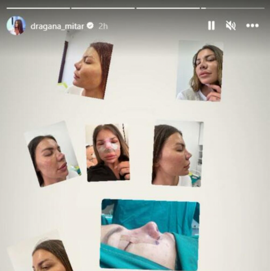 VADILI SU MI HRSKAVICU IZ REBRA! Dragana Mitar prošla kroz pravi pakao, imala čak  sedam operacija nosa