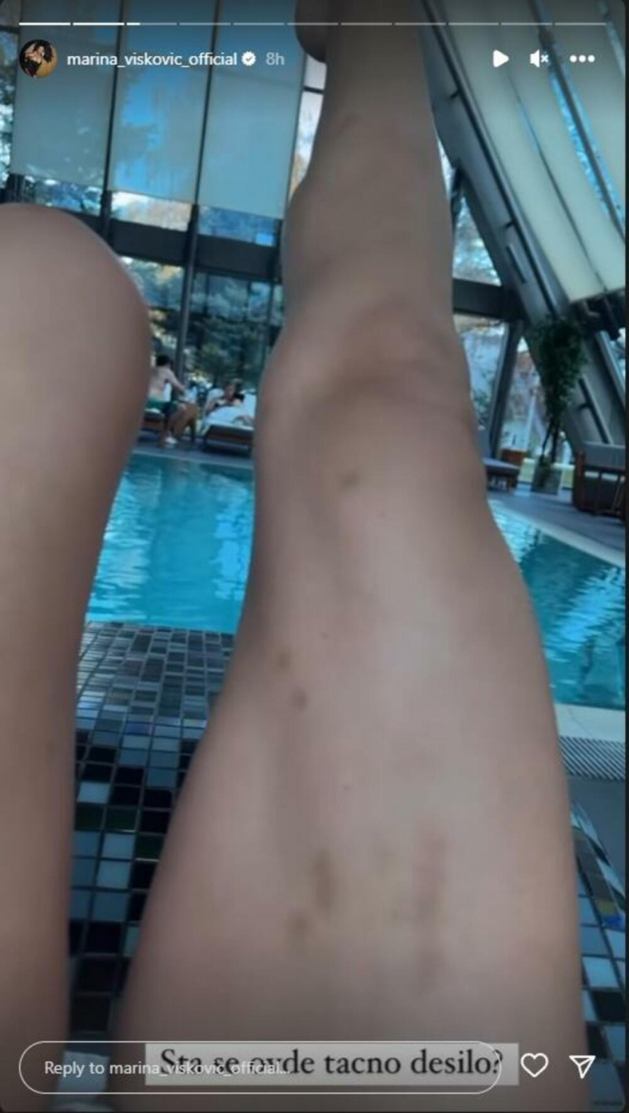 ŠTA SE TAČNO DESILO? Osvanule šok fotografije, Marina Visković u modricama: Ne obraćajte mi se! (FOTO)