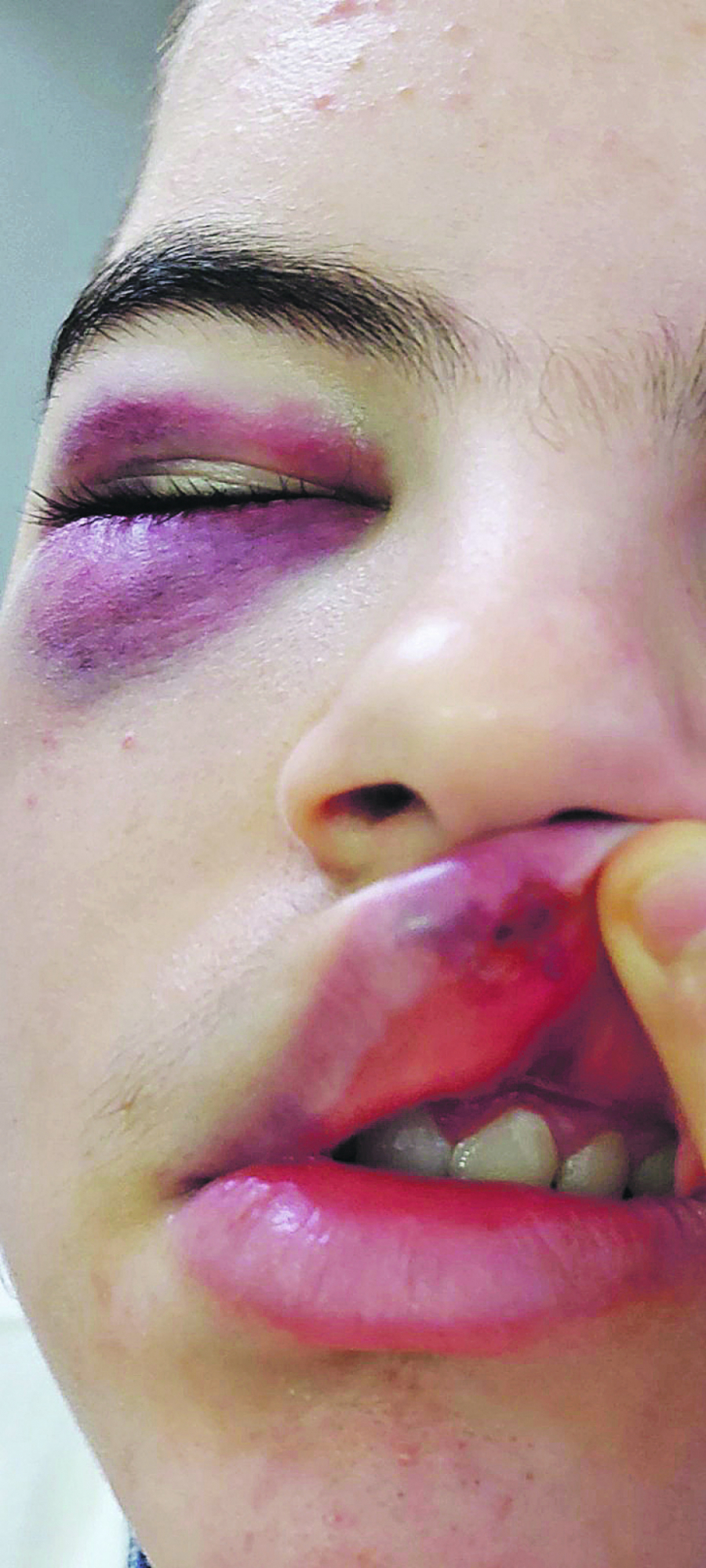 (UZNEMIRUJUĆE FOTOGRAFIJE) CRNI NIZ NASILJA S. S. (15) iz Vlasotinca krvnički pretukao vršnjak na košarkaškom treningu