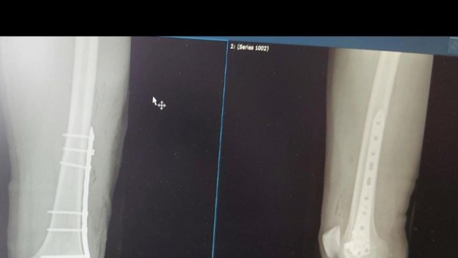 Bilal Brajlović povreda