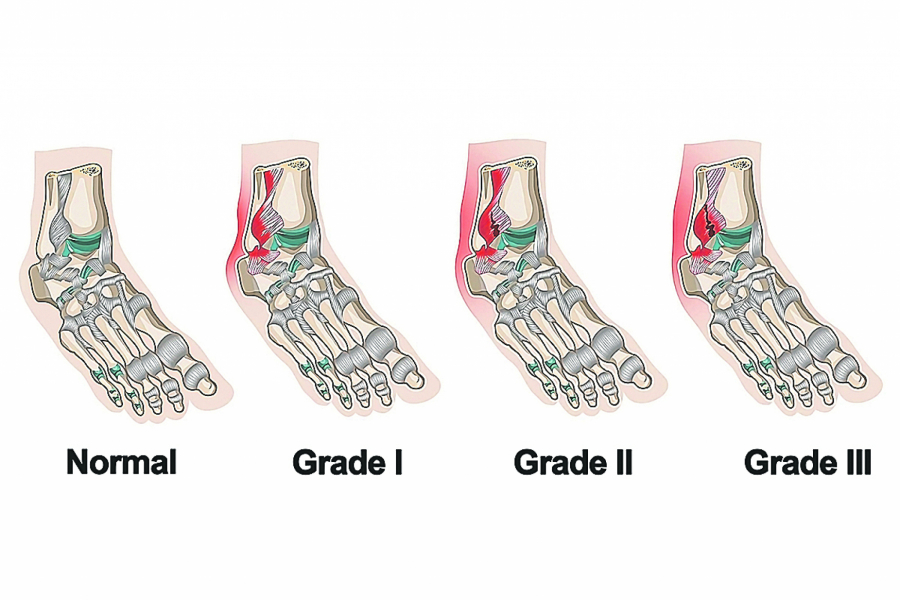 Najčešća zimska povreda OŠTEĆENJE LIGAMENATA jeste bolno, ali je izlečivo