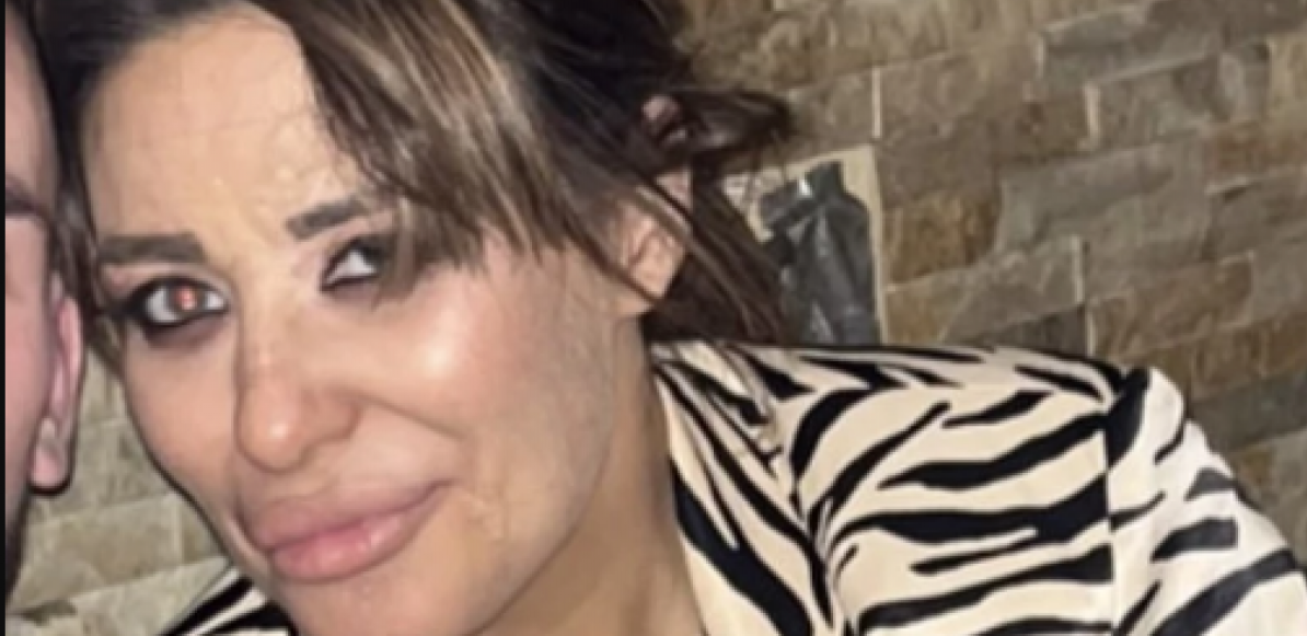 ŠTA SE DESILO SA NJENIM LICEM? Isplivale jezive fotografije Ane Nikolić, PEVAČICA SVA U OŽLJCIMA