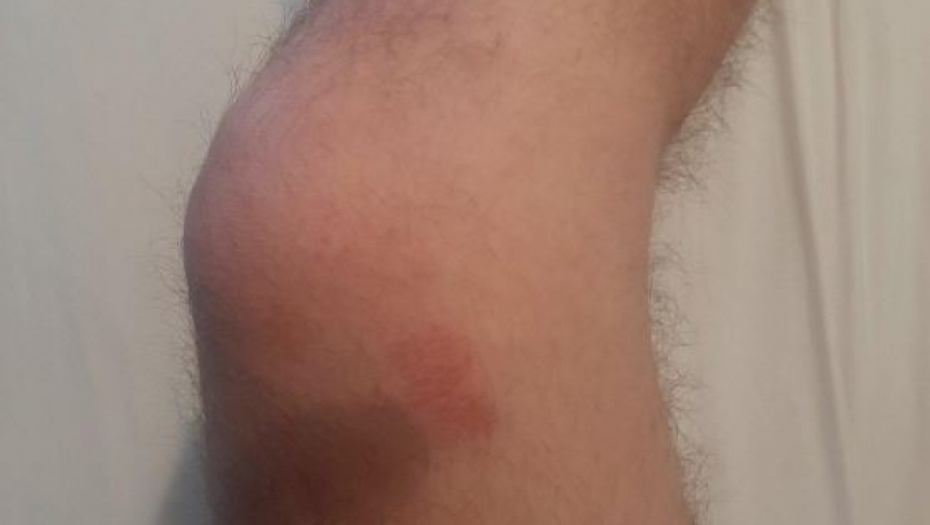 TEROR - JOŠ JEDAN SRPSKI MLADIĆ NAPADNUT NA KiM: Osmorica Šiptara tukla Stefana Tomića!