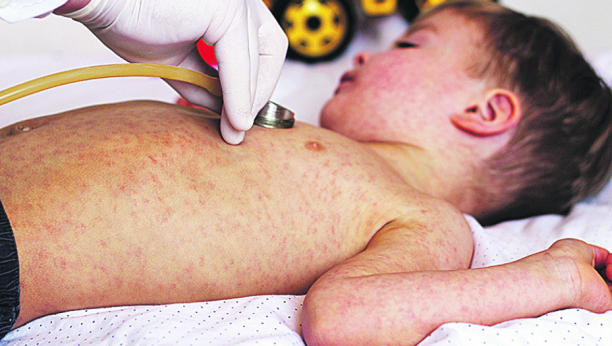 NA KORAK DO EPIDEMIJE Male boginje nisu bezazlene, Batut apeluje: Vakcinišite decu!
