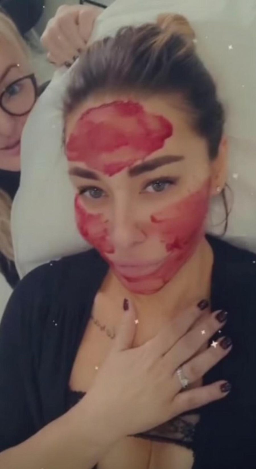 UBRIZGAVALI KRV U LICE Ovo su najbizarnije metode kojima se estrada podvrgla SVE ZA LEPOTU