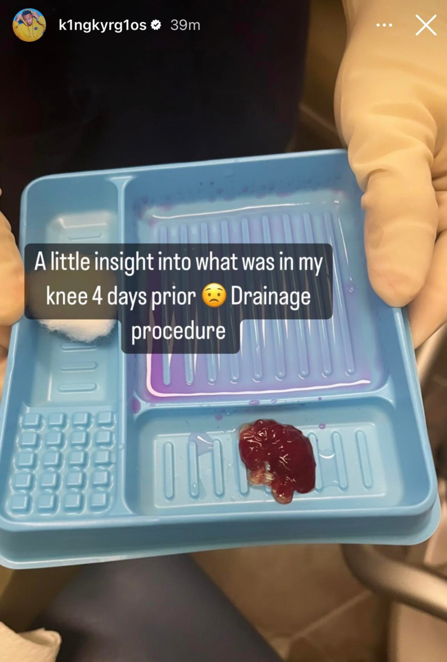 OVO JE STRAŠNO Kirjos pokazao šta mu je izvađeno iz kolena - nije za one sa slabim stomakom (FOTO)