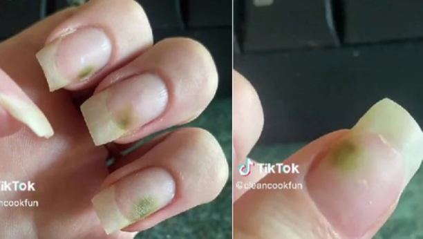 ŽENE BUDITE OPREZNE Devojka podelila kako izgleda kada nokti postanu žrtvom lošeg manikira