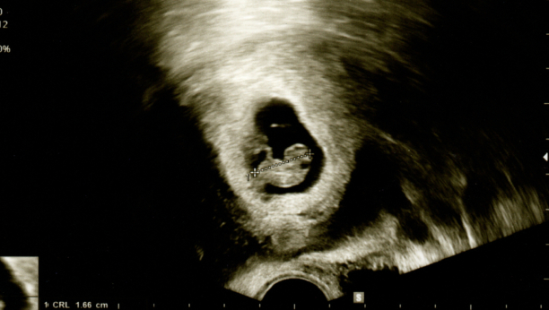 ODAO JE JEDAN DETALJ Momak otišao sa trudnom devojkom na ultrazvuk i shvatio da DETE NIJE NJEGOVO