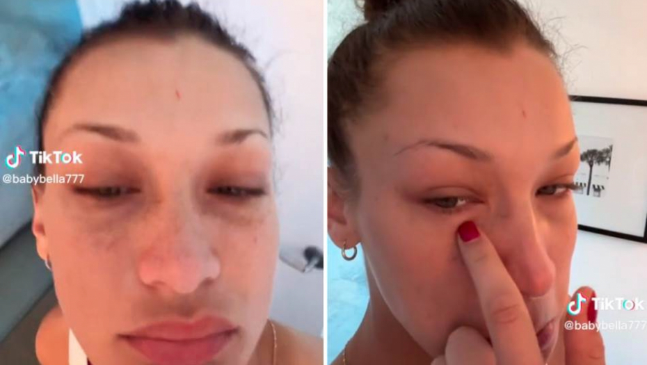 NAJLEPŠA ŽENA SVETA SE SVA IZOBLIČILA Manekenka progovorila o bolesti koja joj napada sve organe