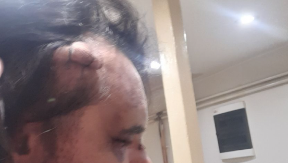 Posledice prebijanja Redžepa Redžepovića Lepog