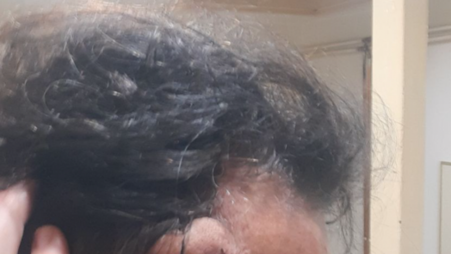 Posledice prebijanja Redžepa Redžepovića Lepog