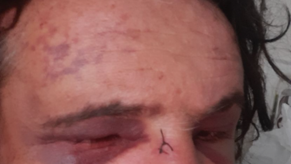 Posledice prebijanja Redžepa Redžepovića Lepog