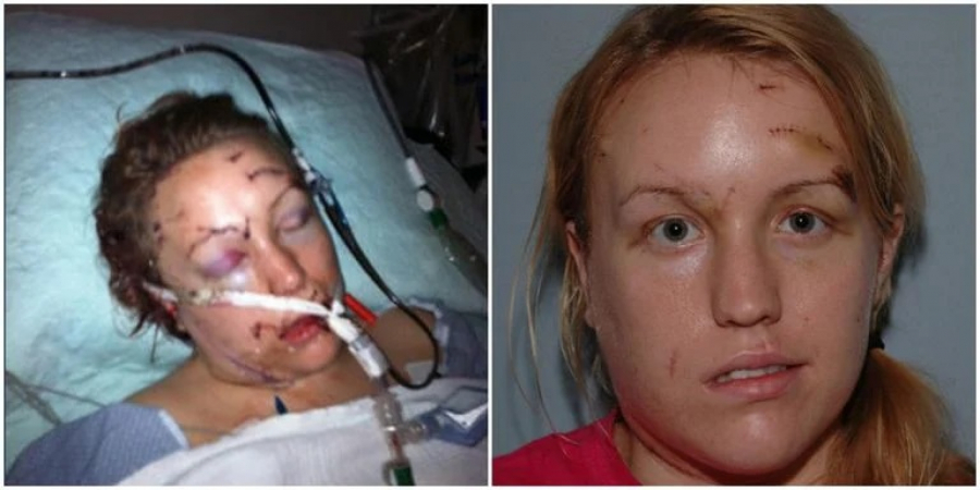 UNAKAŽENA SA 32 UBODA NOŽEM, BUKVALNO MU PALA NA RUKE Melisa žrtva porodičnog nasilja, udala se za bolničara koji joj je spasio život