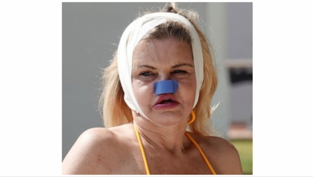 DANIJELI TRULI LICE OD ESTETSKIH ZAHVATA: "Htela sam da izgledam prelepo, sad molim boga da umrem"