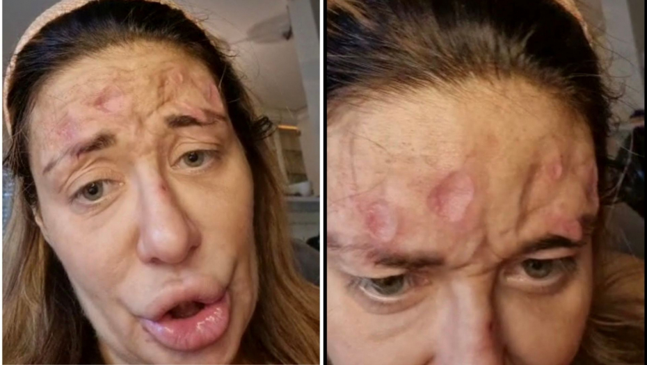 Ana Nikolić pokazala rane na licu