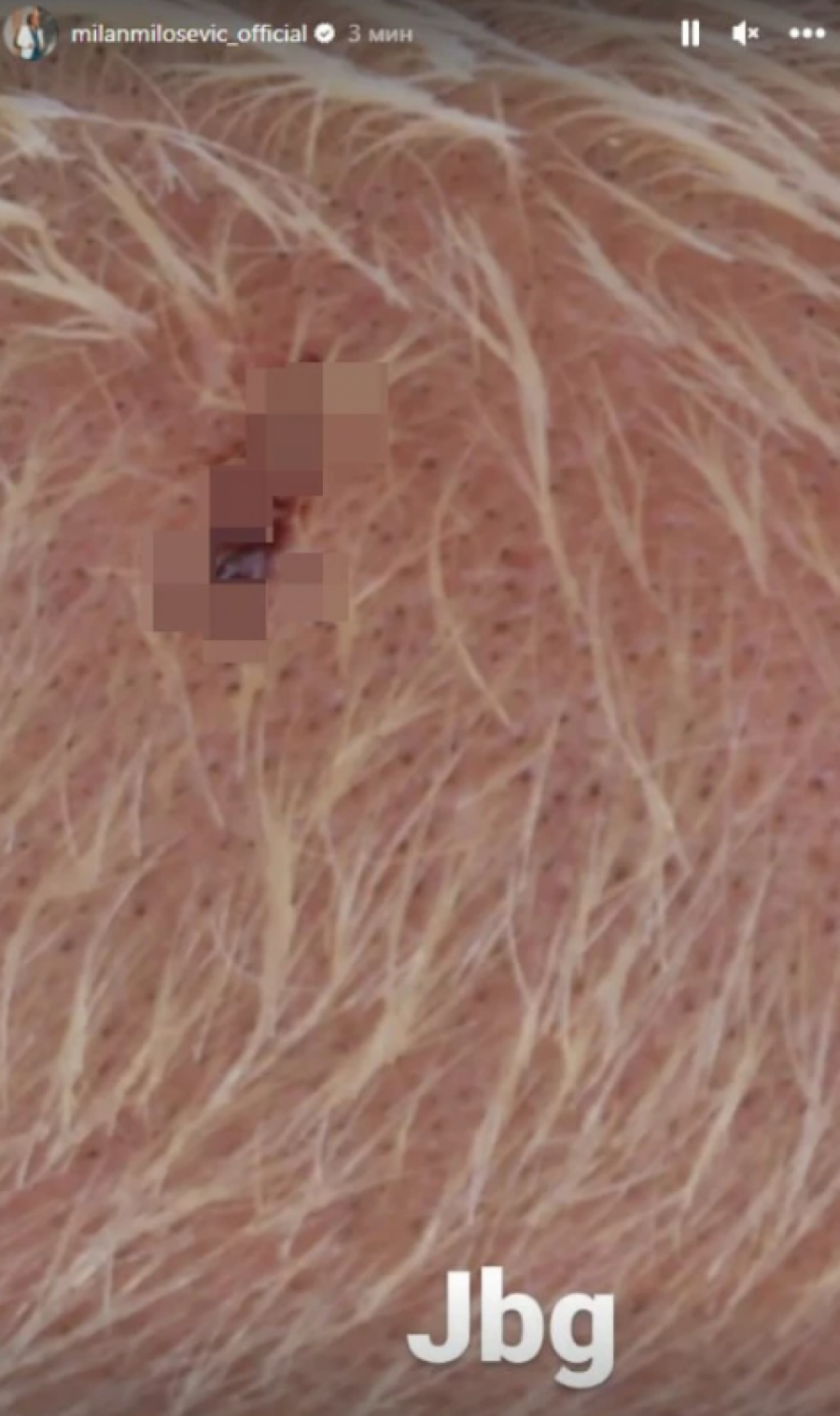 Milan Milošević pokazao povredu