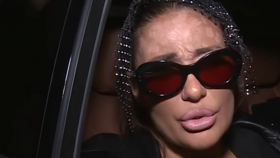 Ana Nikolić ima kratere na licu