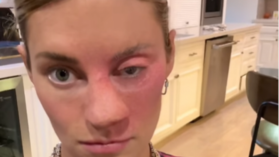 devojka ušmrkala pčelu