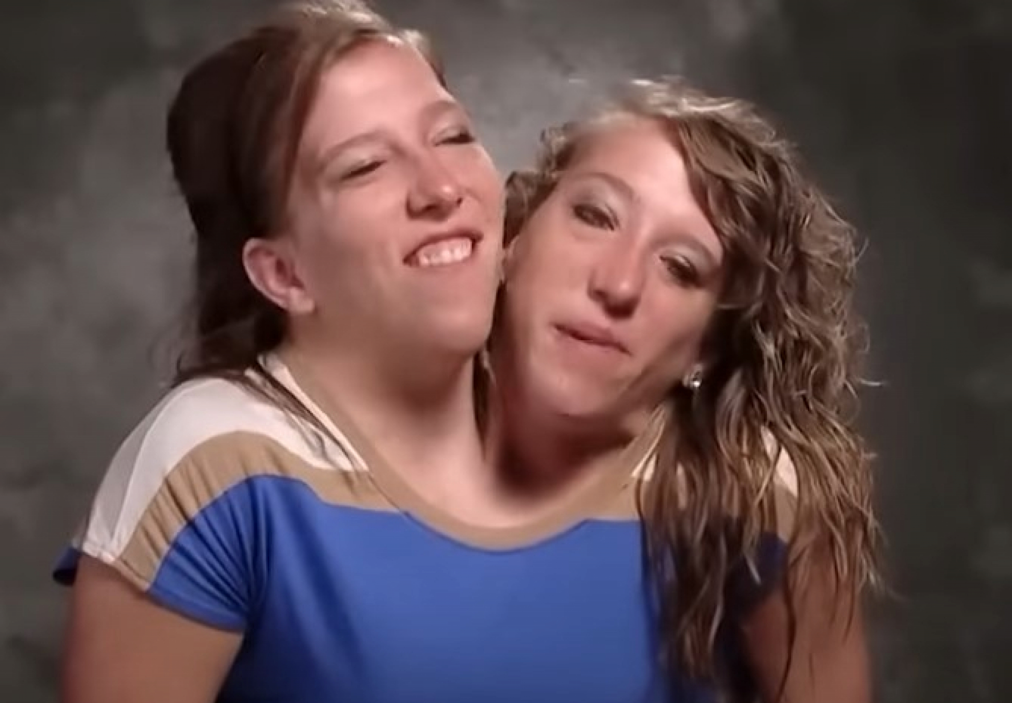 sijamske bliznakinje