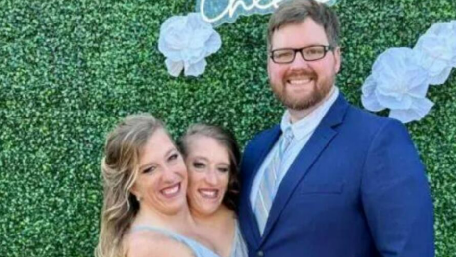 Sijamske bliznakinje