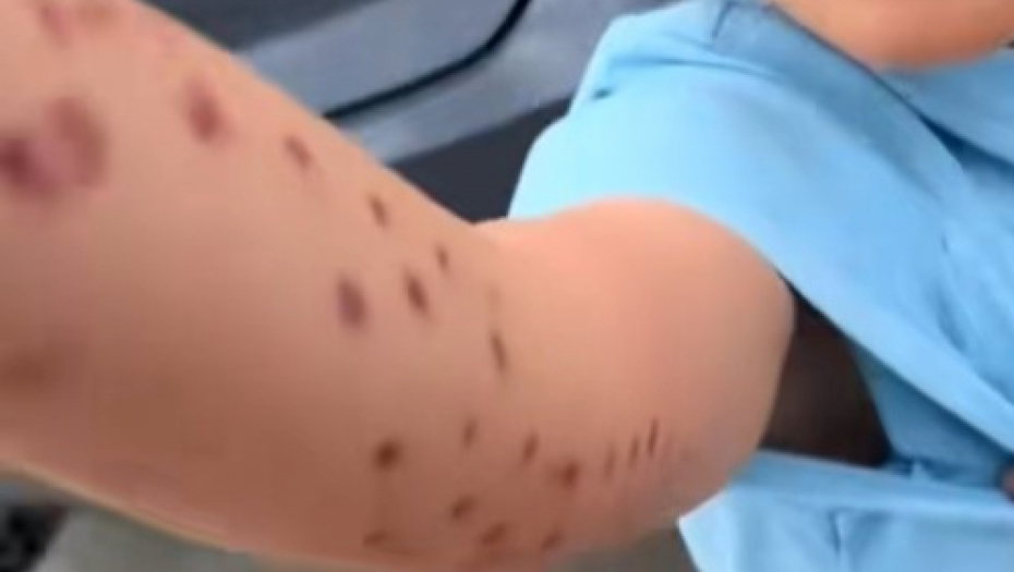 hobotnica napala dete