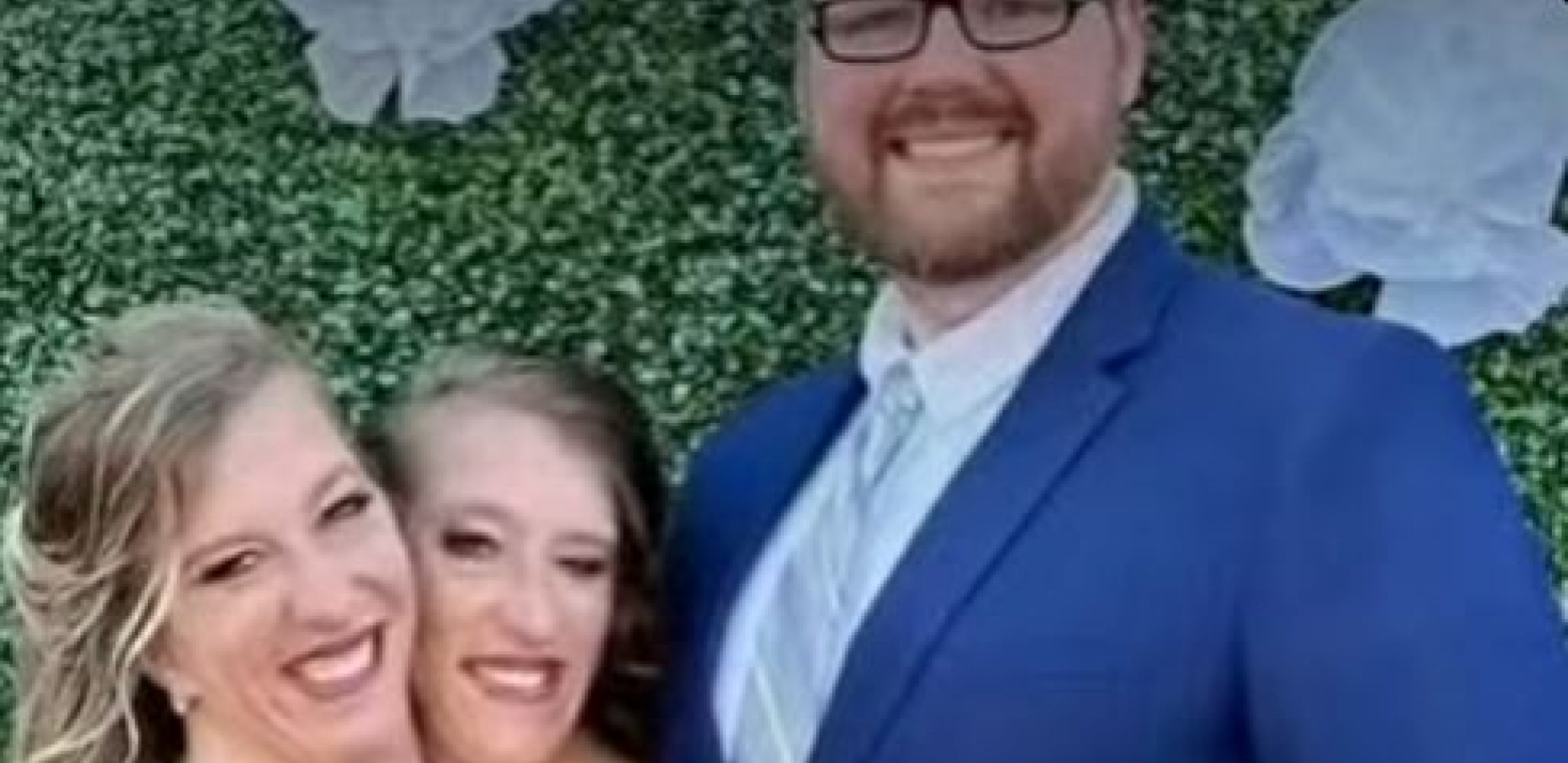 sijamske bliznakinje