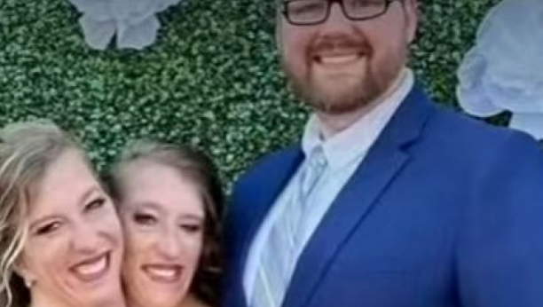 sijamske bliznakinje